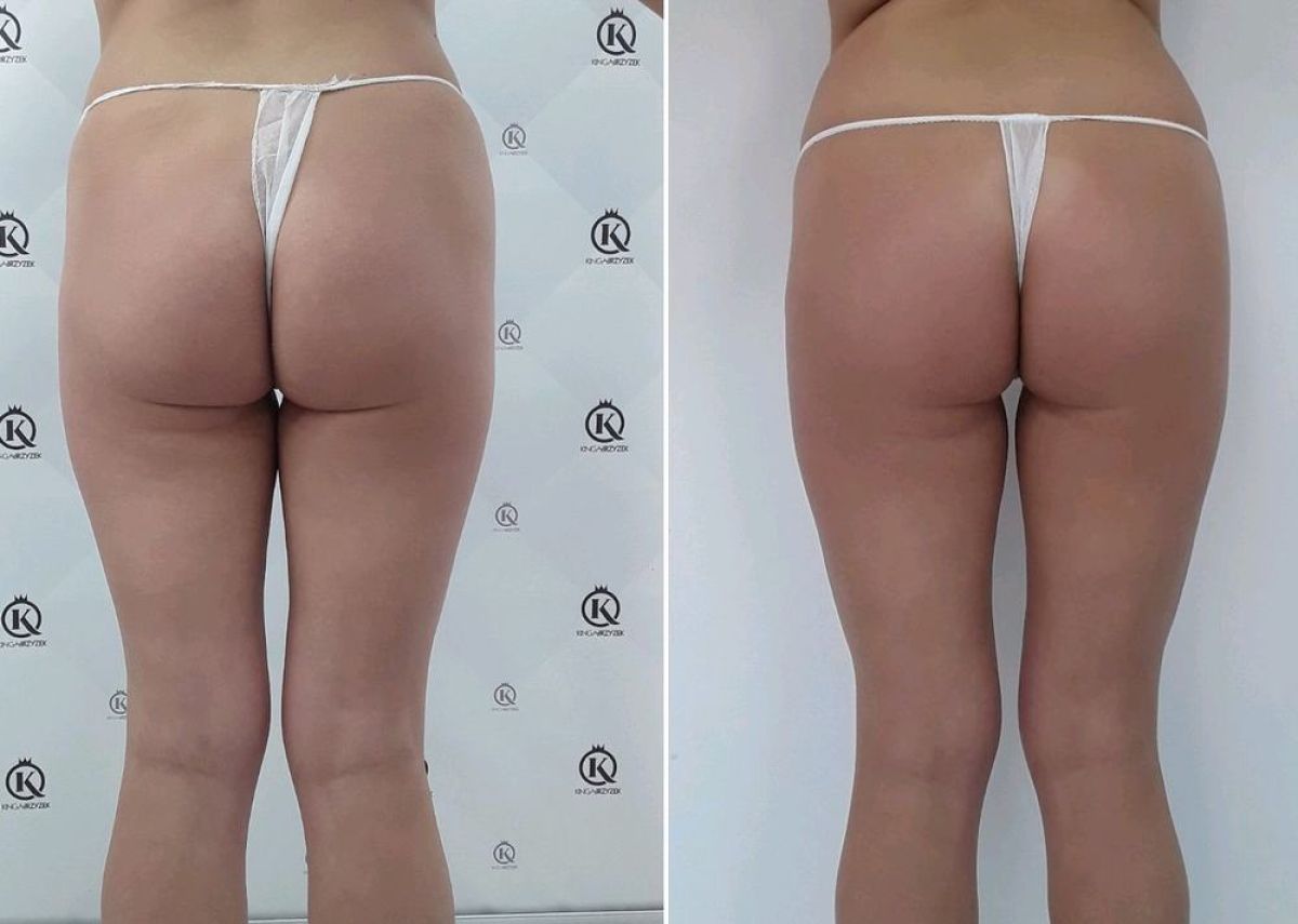 Endermologia Nowy Targ