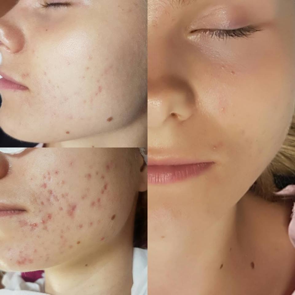 Złuszczanie kwasami Nowy Targ