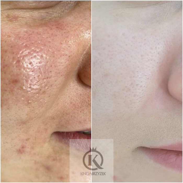 Złuszczanie kwasami Nowy Targ