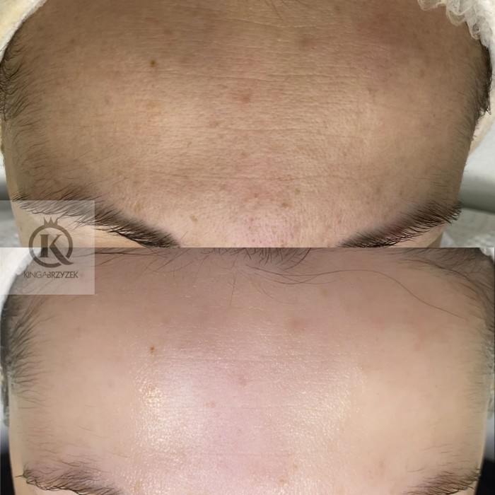 Złuszczanie kwasami Nowy Targ